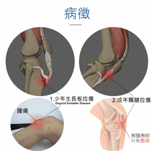 Alternative view of Medex K12 髕骨帶